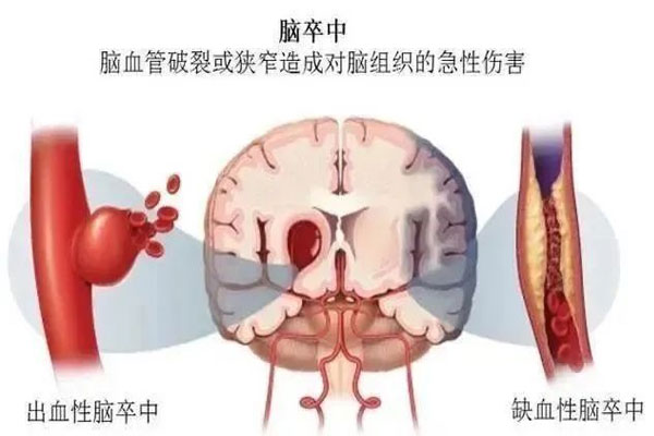 中风,缺血性中风,出血性中风