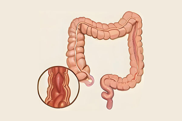 结直肠癌,结直肠癌免疫医治