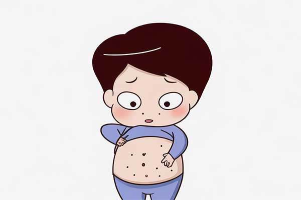 荨麻疹医治,中医疗法,荆防方,桂枝汤,中药药浴