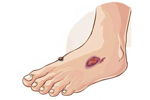 糖尿病足,糖尿病足高危人群,日常防护,就医信号